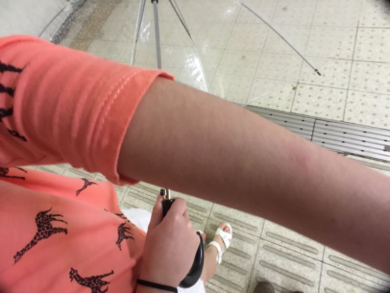 stephs arm with deer bite
